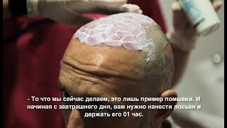 Как нужно мыть голову после пересадки волос.