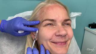 #NEWTOX - Jeuveau is the new Botox