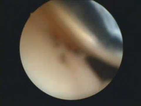 Kniearthroskopie 15.11.2007 - Teil 2 - YouTube