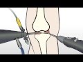 Regenexx Alternative to Knee Meniscus Surgery / Meniscectomy