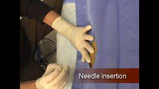 Lumbar Puncture Procedure Explained | Step-by-Step Spinal Tap Technique