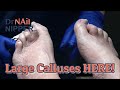 Large Calluses with Dr Nail Nipper. What's Rheumatoid Arthritis [Throwback Thursday]