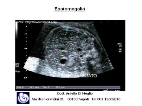 Video: Toxoplasmosi Cronica: Segni, Sintomi E Trattamento