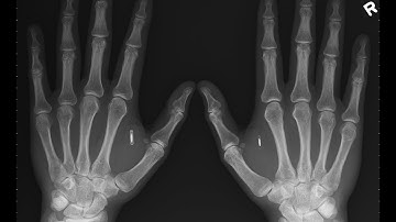 Subdermal NFC chip implants