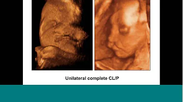 What Ultrasound can detect cleft lip?