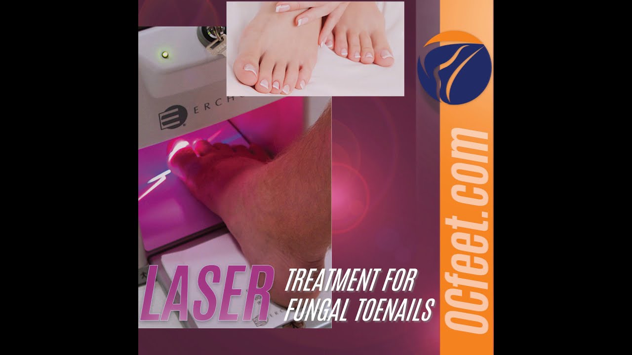 LunulaLaser® Treatment for Fungal Nails - Oakville ON