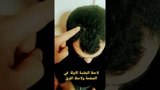 العلاج والحل النهائي لتصاقد االشعر والصلع بالعلاج الدود العلق الطبي في مركزنا في تركيا قونيا