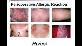 Basic Science - The Allergic Response - Part 2