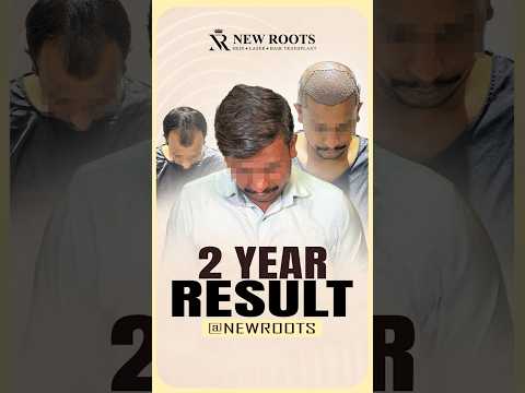 Hair Transplant in Nashik | 2 Years Result | 4000 Grafts Implanted | Marathi #hair #viral #shorts
