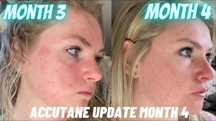 ACCUTANE Update Month 4 | Rashes, Vision Changes, Night Sweats