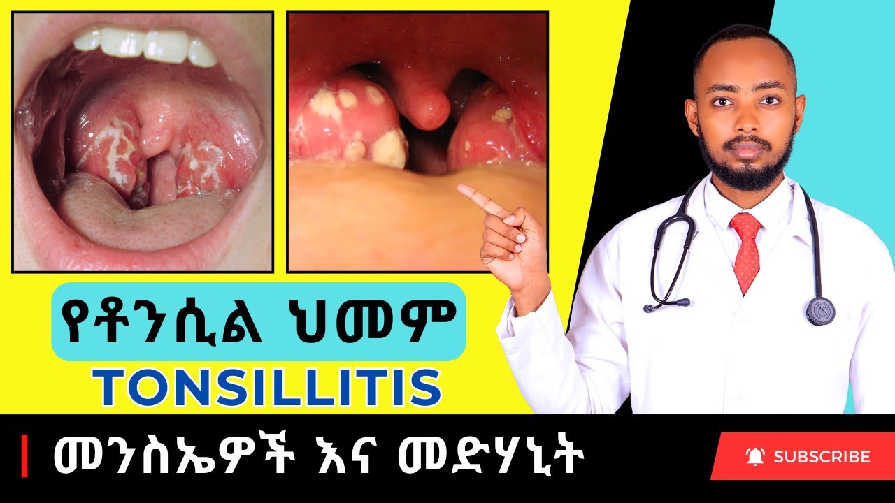 Ethiopia | የቶንሲል ህመም (Tonsillitis) ምልክቶች እና መፍትሄዎች