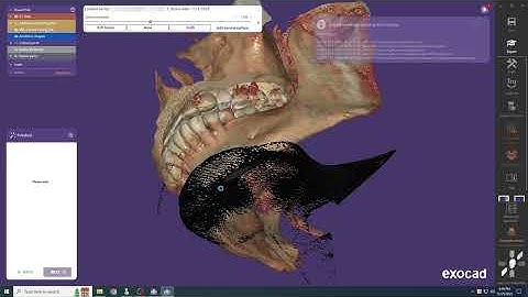 Thiết Kế Máng Hướng Dẫn Phẫu Thuật Một Đơn Vị Răng Đơn Lẻ Bằng Exoplan | Exocad Workflow | FULL