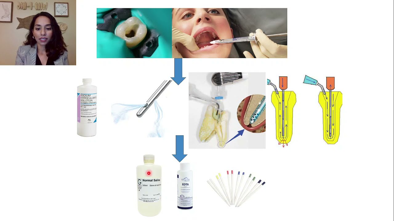 Regenerative Endodontic Procedure Step-by-Step Guide