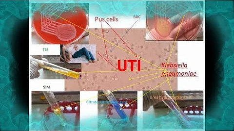 How is Klebsiella UTI treated?