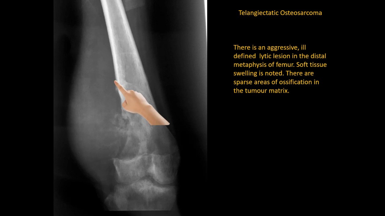 Osteosarcoma Orthopaedic lecture/ FRCS Orthopaedic/ OITE Lecture/DNB Orthopaedic Lecture,