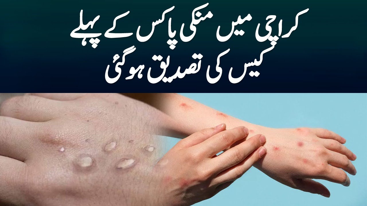 The First Case Of Monkeypox Was Confirmed In Karachi - YouTube