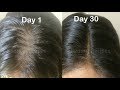 Regrow New HAIR in 30 Days & Cure Baldness | Onion Juice & Garlic for Thick Hair Growth | Thin Hair