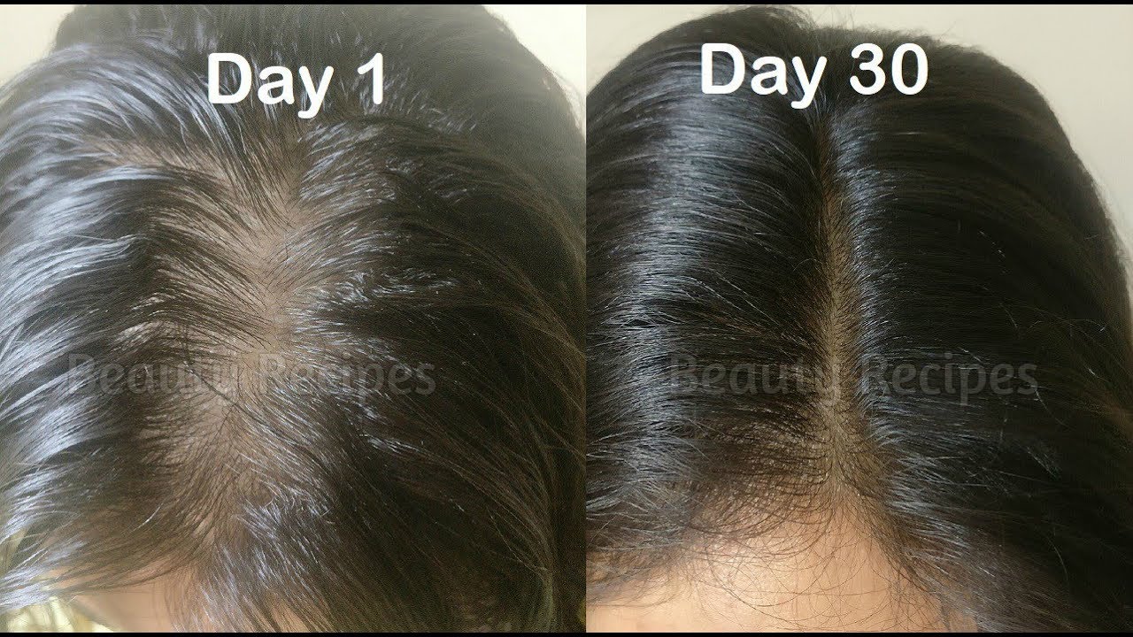 Regrow New HAIR in 30 Days & Cure Baldness | Onion Juice & Garlic for Thick  Hair Growth | Thin Hair - YouTube