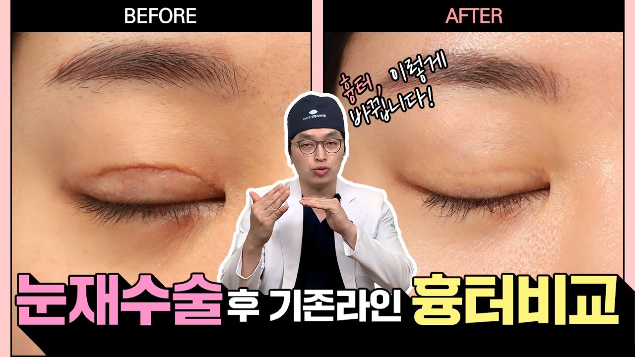 쌍꺼풀 재수술을 하면 기존 라인은 어떻게 될까?