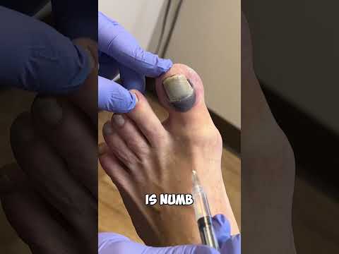 Ouch! Numbing A Toe: A Quick Fix\