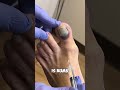 Ouch! Numbing A Toe: A Quick Fix&quot;