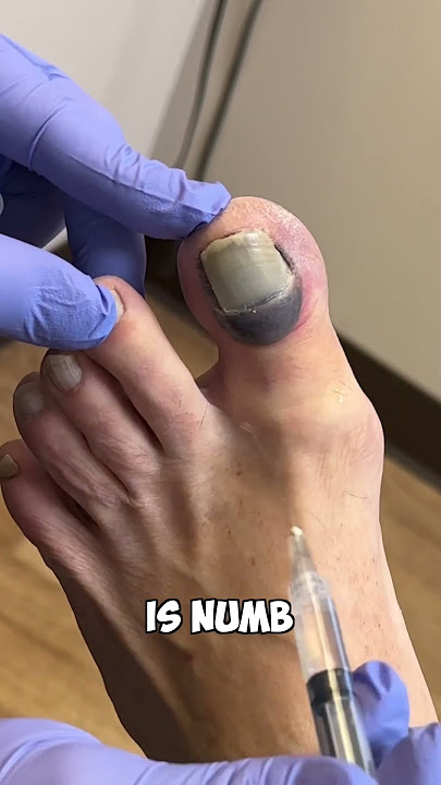 Ouch! Numbing A Toe: A Quick Fix'