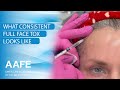 What Consistent Full Face Tox Looks Like