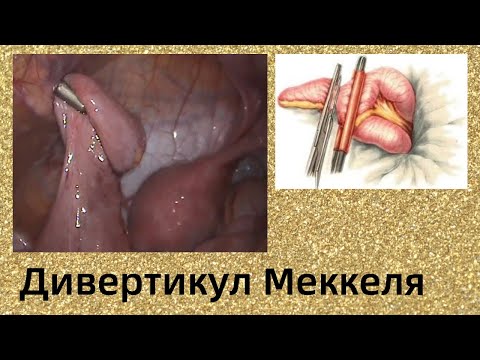 Дивертикул Меккеля. Лапароскопическое удаление.