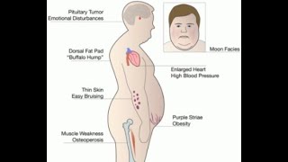 Endogenous Causes And Exogenous Causes Of Cushings Disease