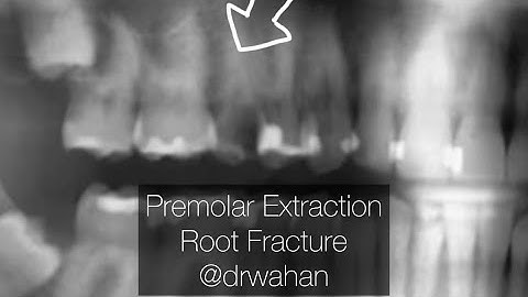 Premolar Extraction with Fractured Root