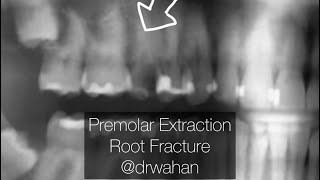 Premolar Extraction with Fractured Root