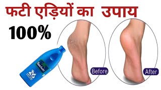 #फटी एड़ियों को बनाए सुंदर ।Cracked heals home remedy।fati adiyan ka ilaj screenshot 5