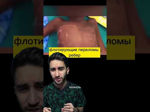 перелом ребер флотирующий