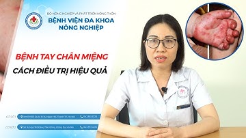 Bệnh tay chân miệng ở trẻ cách nhận biết và điều trị đúng cách