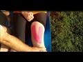Running - Tape Knees for Your Race! BL Physio (RIF REV Series)