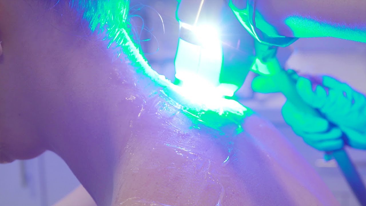 Treating Acne with Broadband Light Therapy BBL™ YouTube