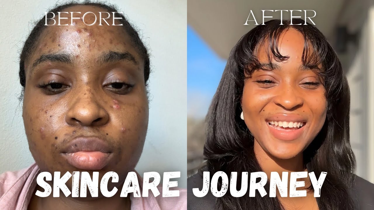HOW I CLEARED MY HORMONAL ACNE | SKINCARE JOURNEY - YouTube