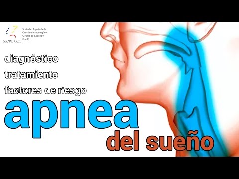 Vídeo: Diferencia Entre La Apnea Del Sueño Y Los Ronquidos
