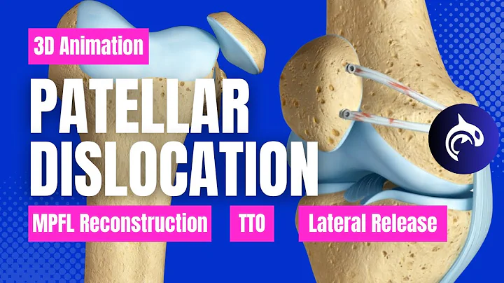 How It's Fixed - Patellar Dislocation: MPFL Repair, Tibial Tubercle Osteotomy, and Lateral Release
