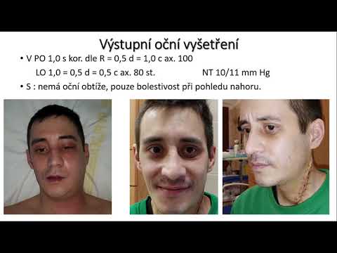 Video: Může hypotyreóza způsobit anasarku?