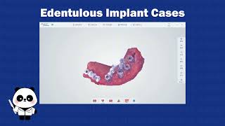 🐼Panda Scanner | Edentulous Implant Cases Studies: Real Clinical Examples 02