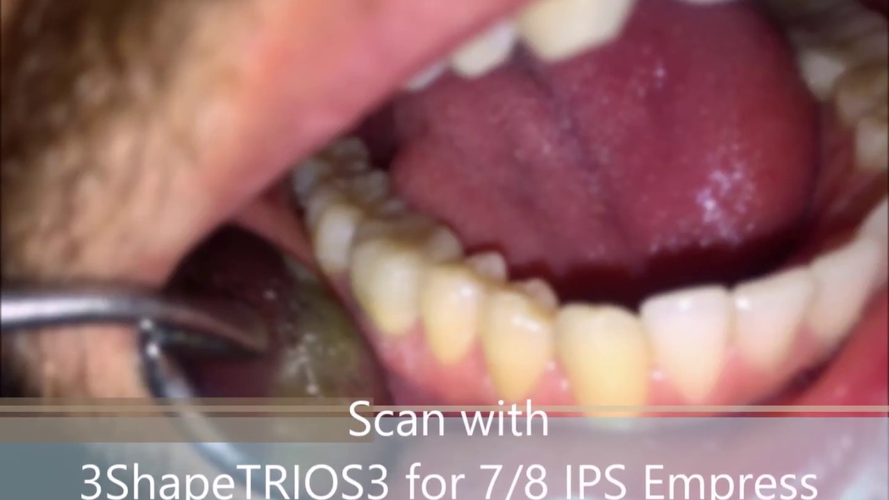 2. Scan with 3Shape TRIOS® 3 for 7/8 IPS Empress CAD crown on tooth #30