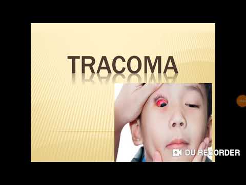 Vídeo: Impacto De Uma única Rodada De Administração De Drogas Em Massa Com Azitromicina Na Prevalência Ativa De Tracoma E Chlamydia Trachomatis Ocular E Cepas Circulantes Na Gâmbia E No S