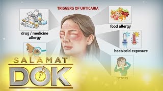 Salamat Dok: Causes and symptoms of urticaria