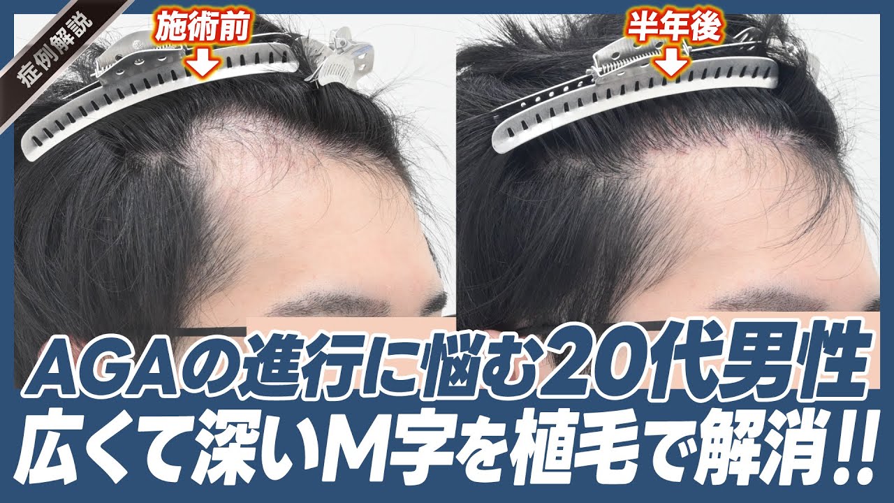 20代男性必見】深くなったM字を解消！治療方法と症例を徹底解説 - YouTube
