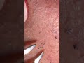 ASMR Beardcare extraction satisfying #beardcare #satisfying #tweezer #asmrbeard #asmrskincare