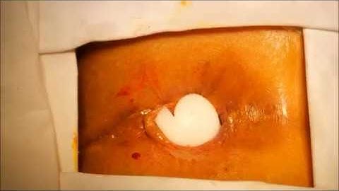Lateral Internal Sphincterotomy for Chronic Anal Fissure under Perianal Anaesthetic Infiltration
