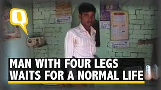 Man With Four Legs Hopes To Lead A Normal Life Someday