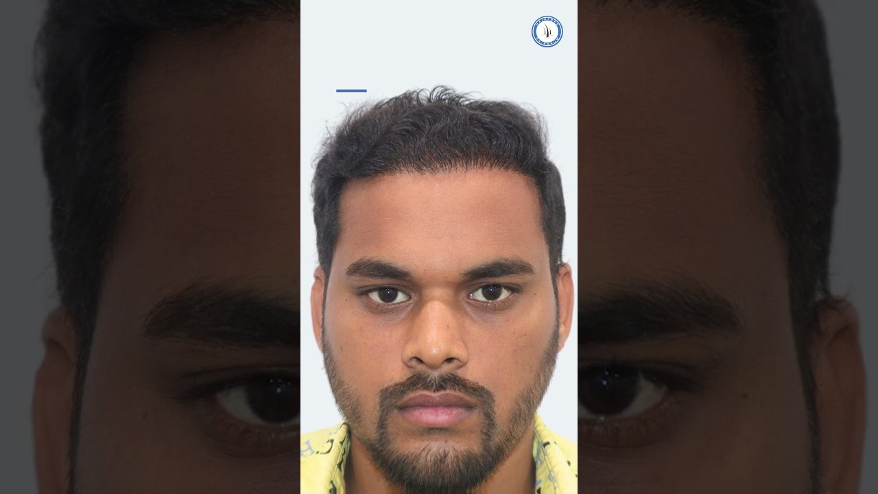 Best Hair Transplant Clinic In Pune|| Hairfree & Hairgrow Clinic