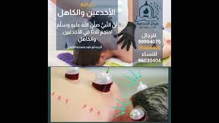 فوائد حجامة الأخدعين والكاهل #الحجامة #اكسبلور #تيك_توك #ترند